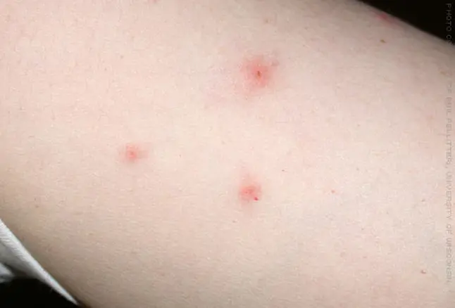 bed bug bite